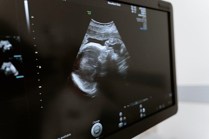 Sonogram vs. Ultrasound